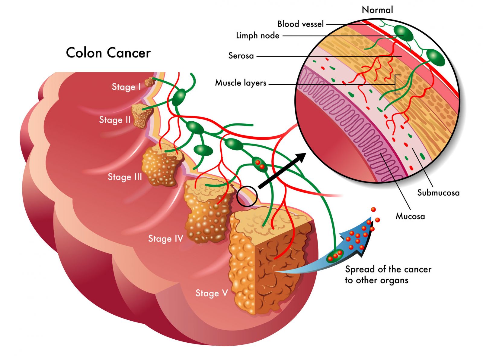 What Stage Of Colon Cancer Symptoms What Are The Four Stages Of 